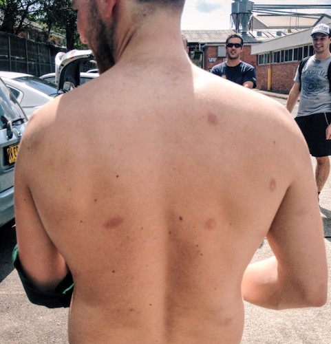 paintball player welts from paintballs